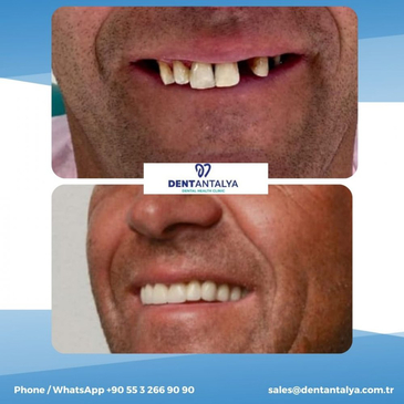 Slider image (2) Dent Antalya